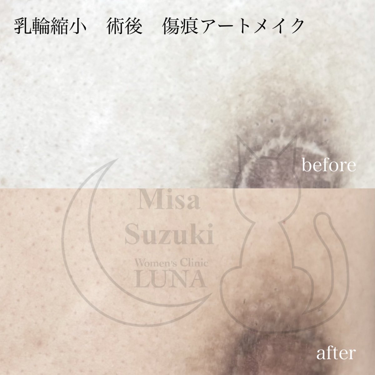 artmake_m's tweet photo. 乳輪縮小後の傷
アートメイクでカモフラージュ
#乳輪縮小
#乳頭縮小
https://t.co/m8OVPnSWDP https://t.co/XM7Ocz274Y