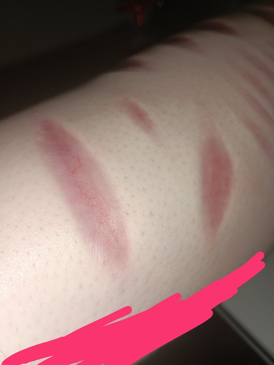 ryuutanchan's tweet image. #shedtwt #shtwt
Atrophic/sunken scars
They're kind of my favorite idk