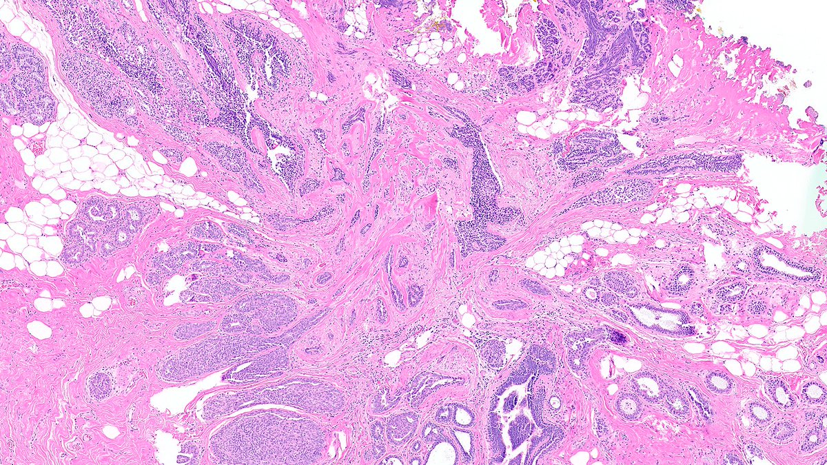 RazaHoda's tweet image. Radial Scar 🫚🔬

A stellate sclerosing lesion with a central fibroelastotic nidus and radiating ducts and lobules with proliferative fibrocystic changes—a close mimic of invasive carcinoma.

#PathX #PathTwitter #breastpath