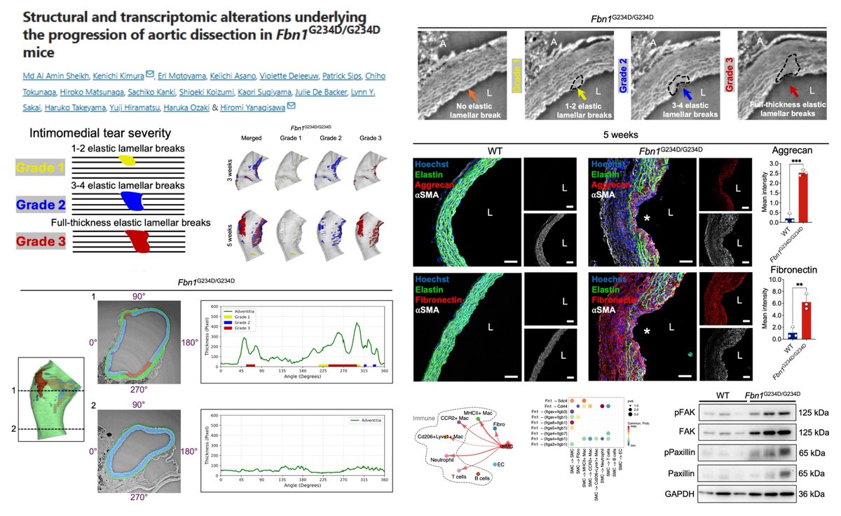 HaoYin20's tweet photo. Another cool Aorta paper from Dr. Hiromi Yanagisawa lab!🤠

Fbn1 G234D🐭➡️Spontaneous ascending aortic dissection at 3~5 wk of age

Very careful immunohistology
+synchrotron X-ray tomography
+scRNAseq analysis into 🐭Intimomedial Tears😎

👉A trend of ⬆️tear volume at inner vs outer aortic curvature
👉Inner medial accumulation of Aggrecan
👉Spatially confined loss of Smooth Muscle Cell contractile proteins at tear sites
👉SMC-immune cell communications
👉Transmural 4x layered transcriptomes of human dilated (n=4) vs dissected (n=3) aortas
👉A potential Fibronectin-Integrin-FAK pathogenic cascade

#AortaEd
@KenichiKimura8 @HYanagisawaLab @SciReports 2026
https://t.co/Pz6PcbhY0q