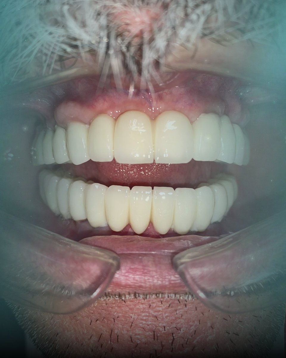 sayginhealth's tweet image. We’re proud to have contributed to your transformation! 💙

For more information and a free consultation:

🌐 sayginhealth.com
📩 info@sayginhealth.com
📞 +90 535 352 49 70

#smiledesign #hollywoodsmile #dentistry #cosmeticdentistry #veneers #porcelainveneers