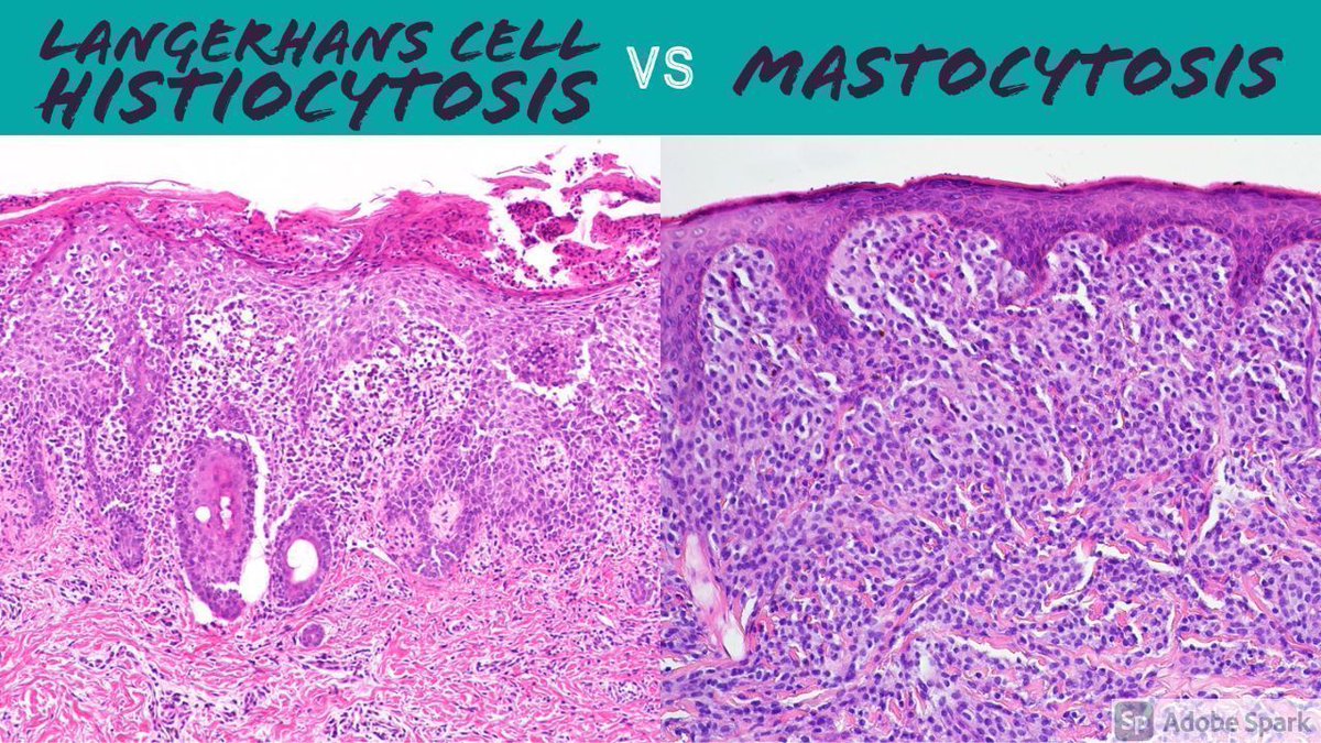 JMGardnerMD's tweet image. How to distinguish Langerhans Cell Histiocytosis (LCH) vs Mastocytosis on H&amp;amp;E only. 
Short Video: youtube.com/watch?v=zfuDpa… 
Classic pics of LCH: kikoxp.com/posts/22380
#pathology #pathologists #pathTwitter #dermpath #dermatology #dermatologia #dermtwitter #pedipath