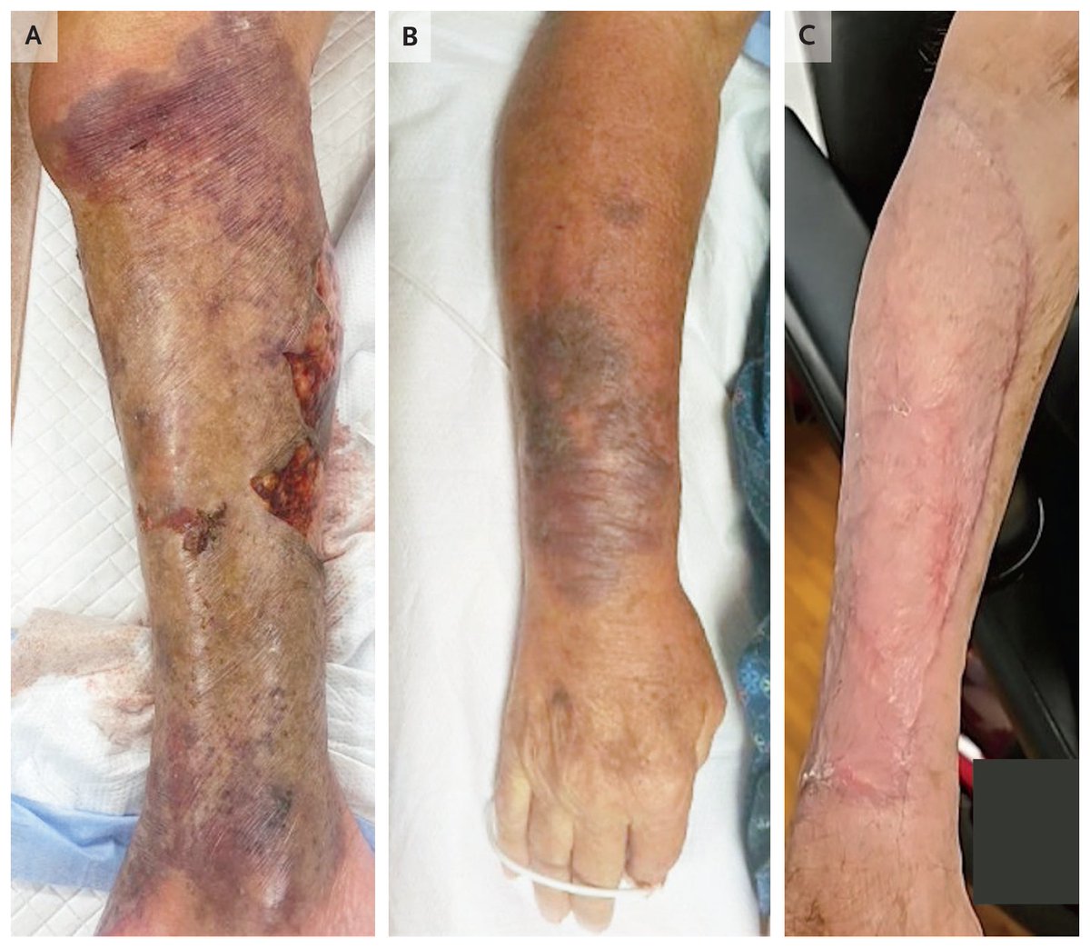 NEJM's tweet image. Images in Clinical Medicine: 𝘝𝘪𝘣𝘳𝘪𝘰 𝘷𝘶𝘭𝘯𝘪𝘧𝘪𝘤𝘶𝘴 Necrotizing Soft-Tissue Infection nejm.org/doi/full/10.10…

#InfectiousDisease #ClimateChange