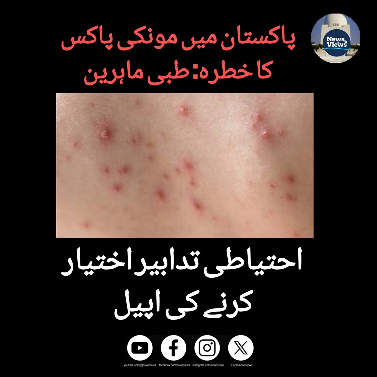 SaadMehmoo42823's tweet image. پاکستان بھر میں مونکی پاکس (Monkey Poks) کے حوالے سے طبی ماہرین نے الرٹ جاری کر دیا ہے-
عالمی سطح پر وائرس کے پھیلاؤ کے پیشِ نظر ہسپتالوں میں مشتبہ مریضوں کے لیے خصوصی وارڈز مختص کیے.

#mpox #MpoxVirus #PublicAwareness #HealthNews #PakistanNews #medicalalert