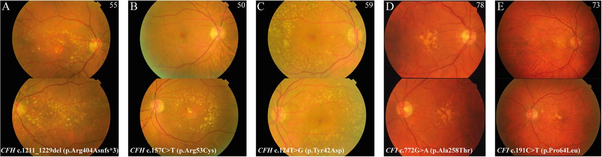 AAOjournal's tweet image. Geographic atrophy in patients with age-related macular degeneration is associated with rare variants in complement factor H and complement factor I
ow.ly/tlhR50YChEB
#ophthalmology
