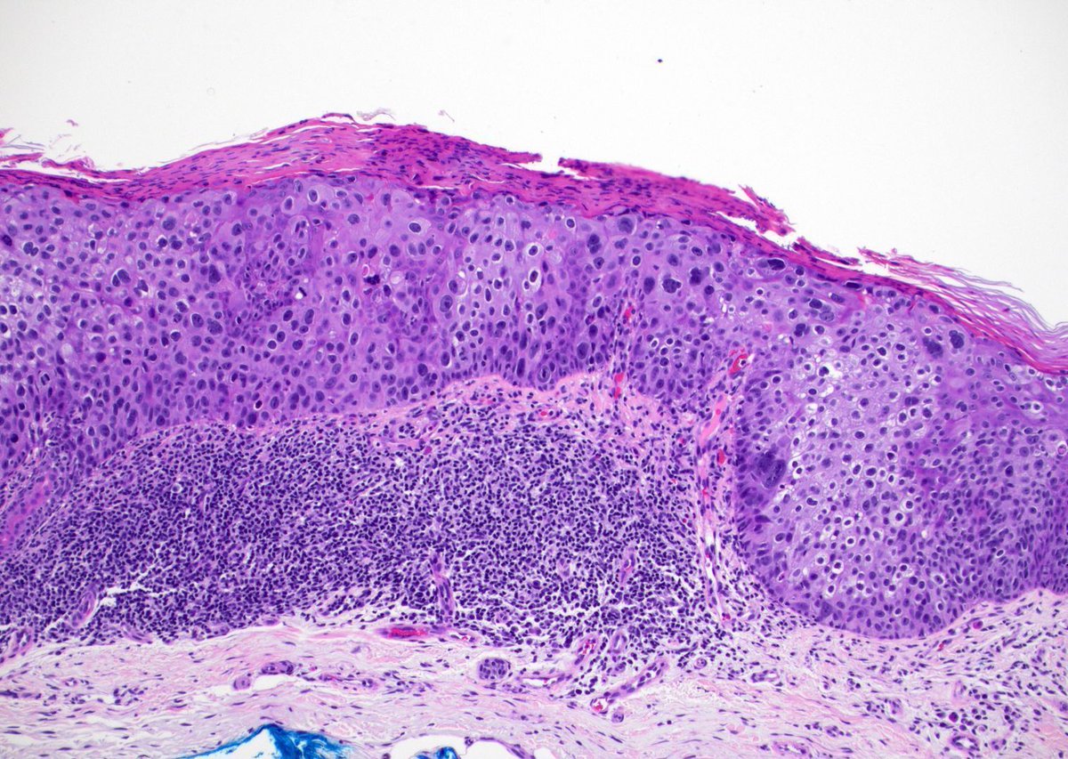 JMGardnerMD's tweet image. Red plaque on leg of elderly woman. 
Diagnosis ✅  youtu.be/jyjc2U4Qmfo?si… 
How do you know this is NOT melanoma in situ on H&amp;amp;E with no immunostains?
Answer &amp;amp; more pics: kikoxp.com/posts/17377 
More info: youtu.be/vWSw-0EwHvw?si… 
#pathology #pathologists #pathTwitter