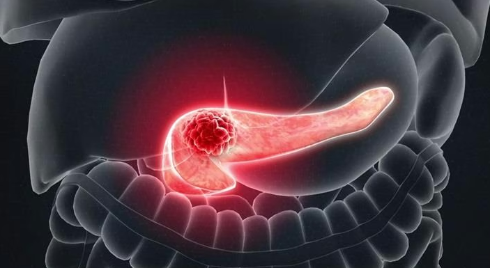 zeyneepozturkk_'s tweet image. Mayo Clinic’in geliştirdiği yapay zeka modeli REDMOD, pankreas kanserini klinik tanıdan ortalama 475 gün önce saptayabiliyor. Erken teşhisle tedavi ve sağkalım için kritik fırsat sunuyor. #AI #YapayZeka #Teknoloji