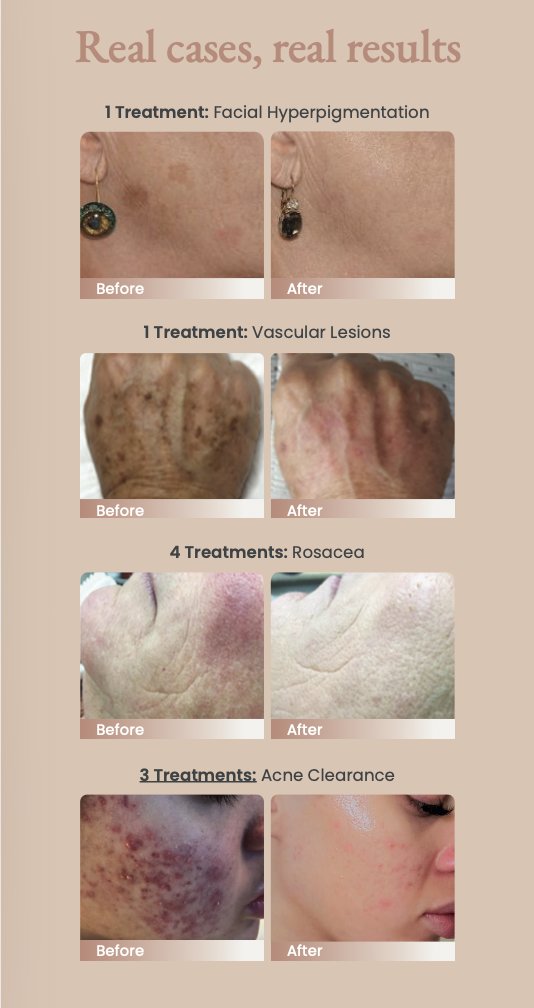 MagnifiqueLaser's tweet photo. I’ll walk you through your first laser visit: intake + skin analysis, a patch test, and a personalized plan for your skin type. Sessions are efficient (usually under an hour) and priced by treatment area—safety and expertise come first! Ready to feel confident? #LaserTreatments https://t.co/SypD7FUXcP