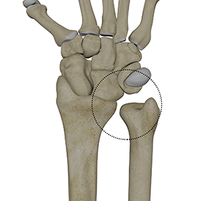 MedEd_Cases's tweet photo. The piano key test evaluates for distal radioulnar joint instability. Stabilize the radius with one hand while grasping the ulna with the other, then apply alternating dorsal and volar translation to assess joint stability. A positive test is indicated by pain or excessive laxity, suggesting instability of the distal radioulnar joint. Sensitivity is 65 to 66%, specificity 44 to 68%.

Read: https://t.co/lS1ZP7xqSv

Watch: https://t.co/ATX2BcIluc

#MedicalEducation #MedEd #Physio #ATC #Orthopedics #SportsMedicine #PhysicalTherapy #AthleticTraining #Rehab #InjuryPrevention #SportsInjury #SportsRehab #PhysioTherapy  #FOAMed