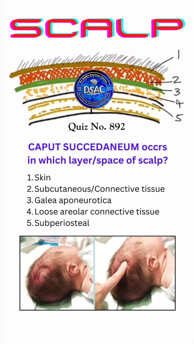 docazmi's tweet image. Q. 892. Caput succedaneum occurs in which layer/space of the scalp? #anatomystudy #mbbs #neetpg