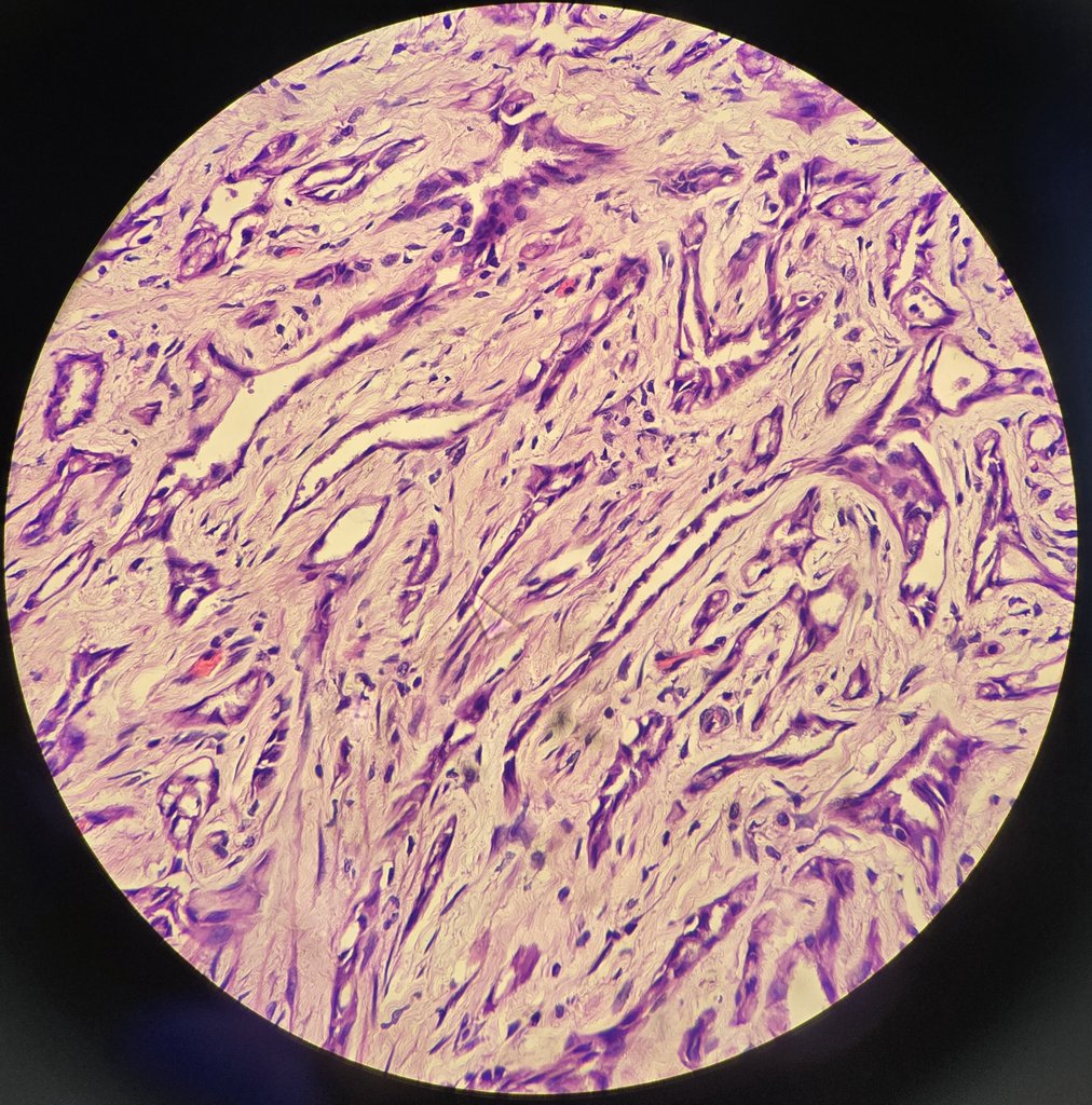 SyedSal55391459's tweet image. #histopathology
#pathX
#pathTwitter
#testis
#photomicrograph 
Dx: Adenomatoid tumor.