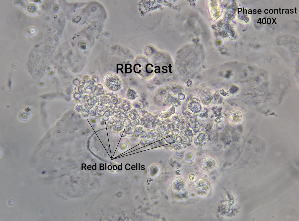 neph_ag's tweet photo. #UrinarySediment patient with proliferative GN and AKI due to ANCA vasculitis.
#UrineMicroscopy https://t.co/fnsXMtTqoU
