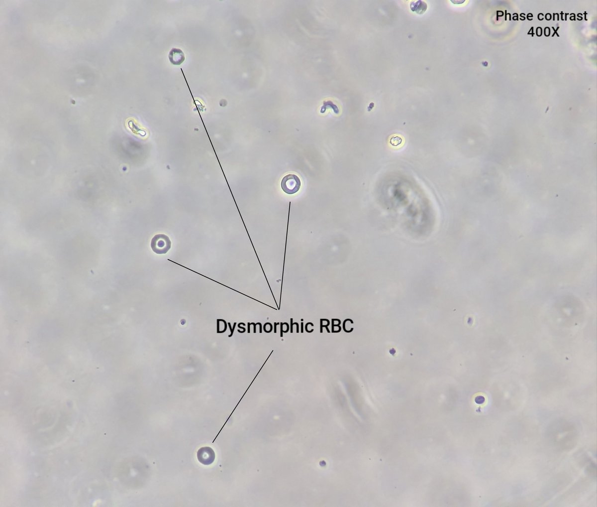 neph_ag's tweet photo. #UrinarySediment patient with proliferative GN and AKI due to ANCA vasculitis.
#UrineMicroscopy https://t.co/fnsXMtTqoU