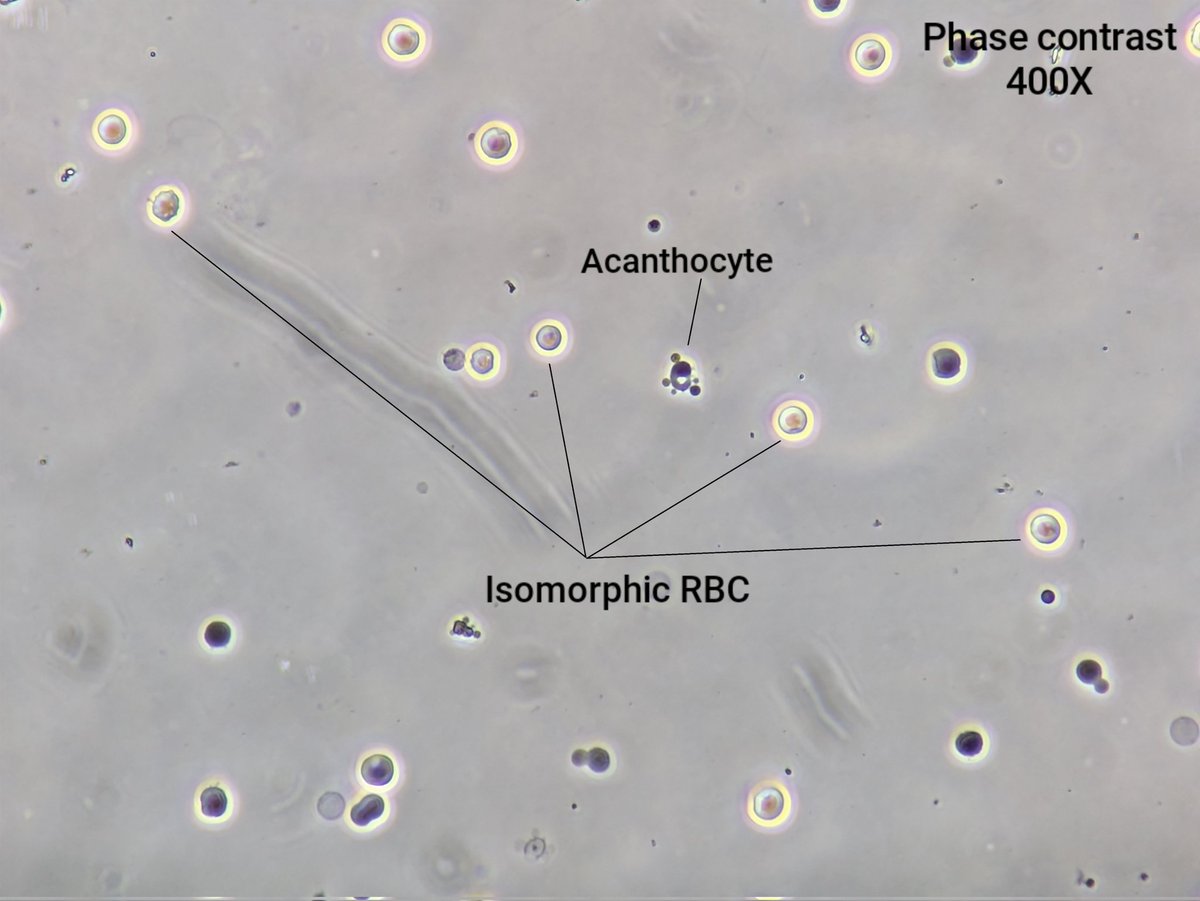 neph_ag's tweet photo. #UrinarySediment patient with proliferative GN and AKI due to ANCA vasculitis.
#UrineMicroscopy https://t.co/fnsXMtTqoU