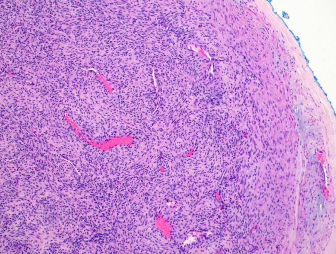JMGardnerMD's tweet image. 45 yo man. Lower leg subcutaneous nodule. Clinical: "rule out cyst" (nope!). 
Answer ✅ youtu.be/ZbFY0Bi0lGM?si… 
More pics: kikoxp.com/posts/2982/pub…
#BSTpath #pathology #pathologists #pathTwitter #dermpath #dermatology #dermatologia #dermtwitter