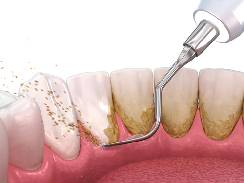 mdicawaynenj's tweet image. Following scaling and root planing treatment at Fine Dental Care, please follow these instructions to ensure optimal healing and recovery. #newjersey #implant #dentist bit.ly/4cXfZrF