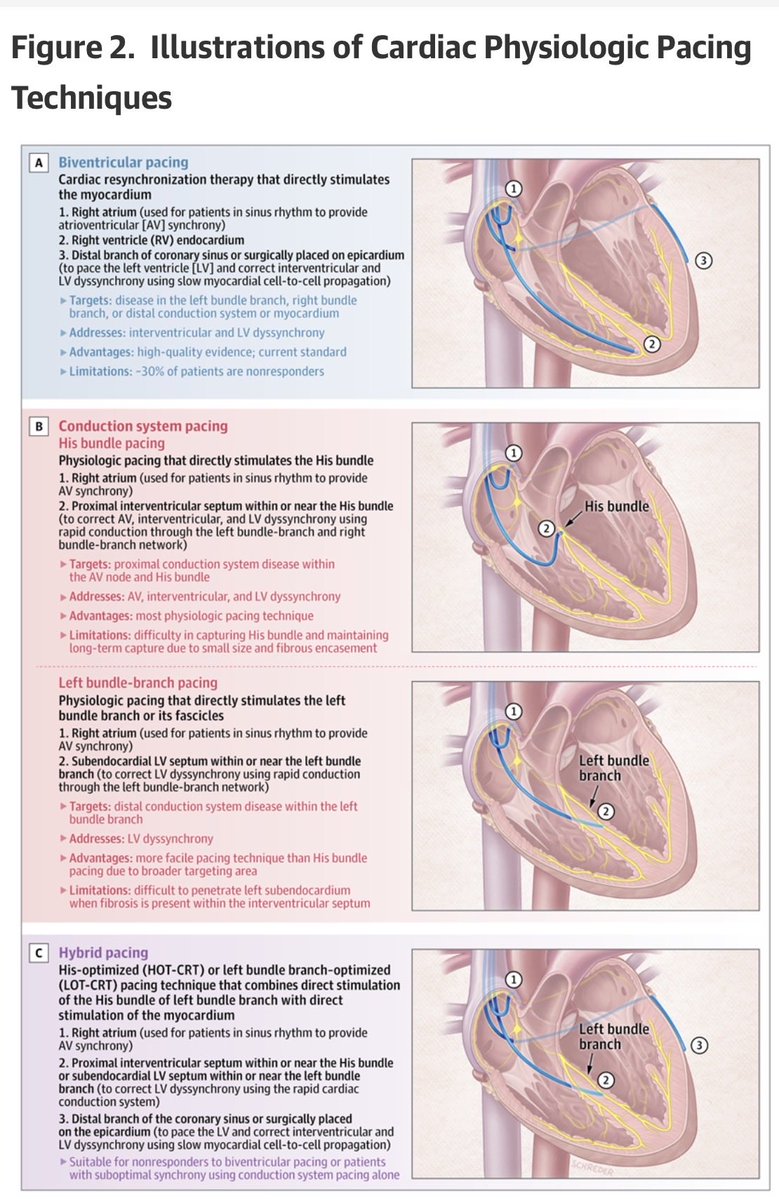 Ed_Alania's tweet image. ⚡️ Cardiac Resynchronization Therapy: A Review @JAMANetwork #Cardiology #CardioEd #Epeeps #FOAMed