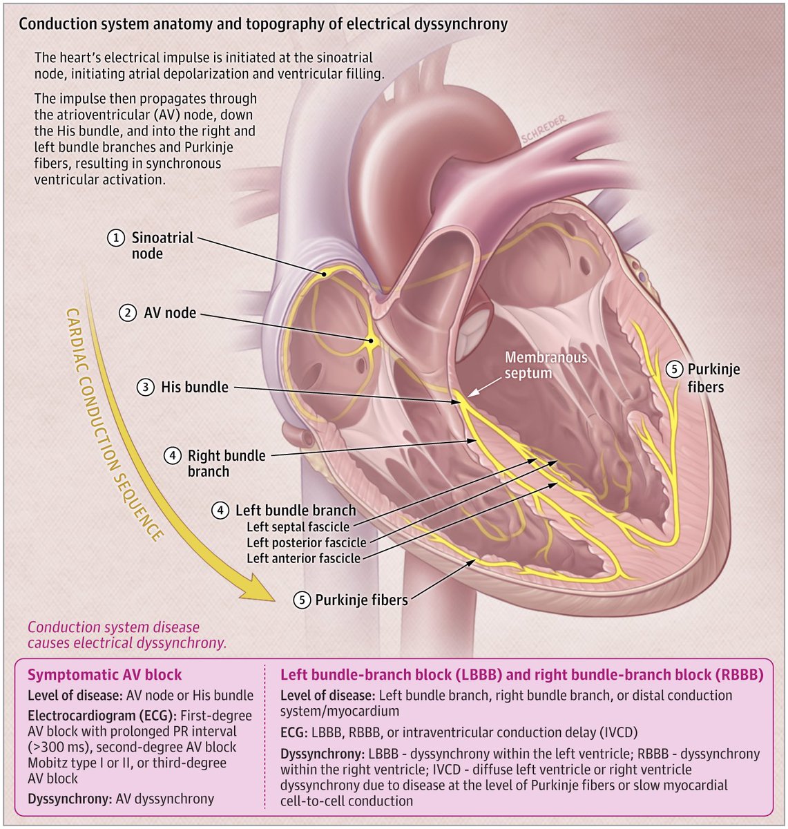 Ed_Alania's tweet image. ⚡️ Cardiac Resynchronization Therapy: A Review @JAMANetwork #Cardiology #CardioEd #Epeeps #FOAMed