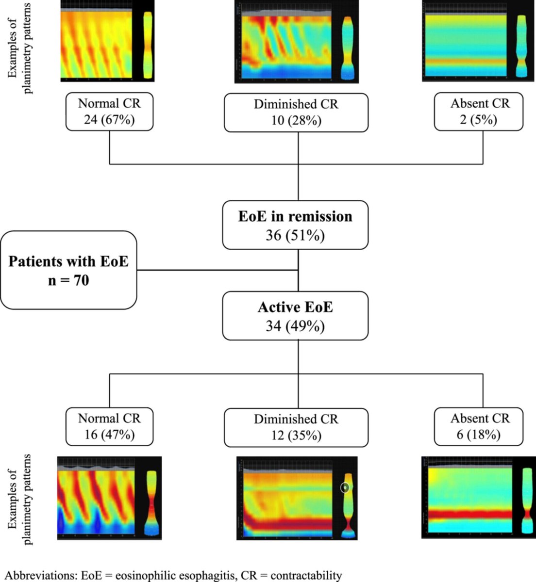 JPGNonline's tweet photo. In pediatric EoE, is histologic remission enough? 🤔

EndoFLIP shows improved distensibility with treatment, but some patients still have abnormal mechanics despite “remission.”

Function may tell a different story.
https://t.co/VXHMjNKBox

#pediatrics #pedsgi https://t.co/n6OX3iCh6G