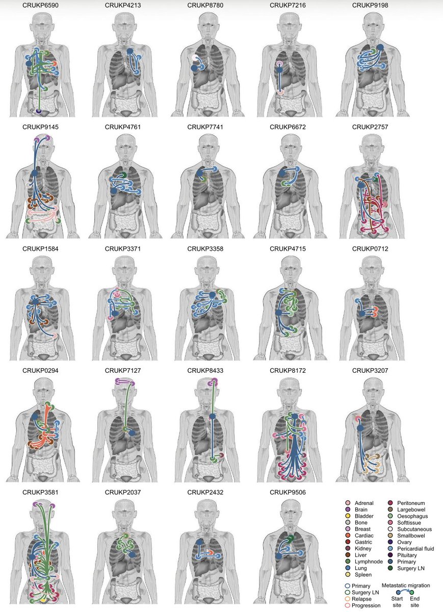 SonyaHessey's tweet photo. Using MACHINA from @benjraphael's lab to infer metastatic migration patterns, we found that NSCLC primaries had multiple seeding subclones more often than a single seeding subclone. 4/9 https://t.co/eOifPIqa7i