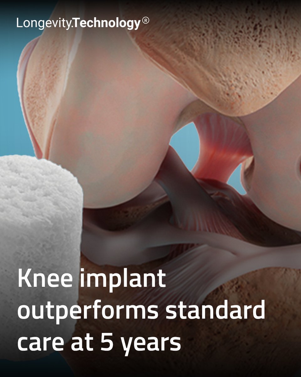 LongevityTech's tweet image. New trial data point to longer-lasting mobility gains, expanding options for patients stuck between early damage and full joint replacement.

vist.ly/42bqv

#longevity #geroscience #mobility #orthopedics #innovation

@SmithNephewPLC