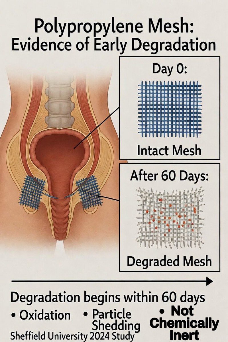 SusanMorgan19's tweet image. Update on my formal challenge to MHRA re: Sheffield University’s 2024 study showing polypropylene #mesh degrades &amp;amp; sheds particles within 60 days.

The MHRA have acknowledged my concerns (CEO 20585 CEC 251941) and are now “investigating” with a full review. 
Grateful for the