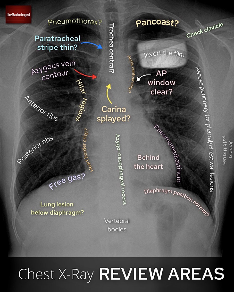radiologistpage's tweet photo. Chest X-Ray review areas and anatomy https://t.co/etMJ7a1OGz
