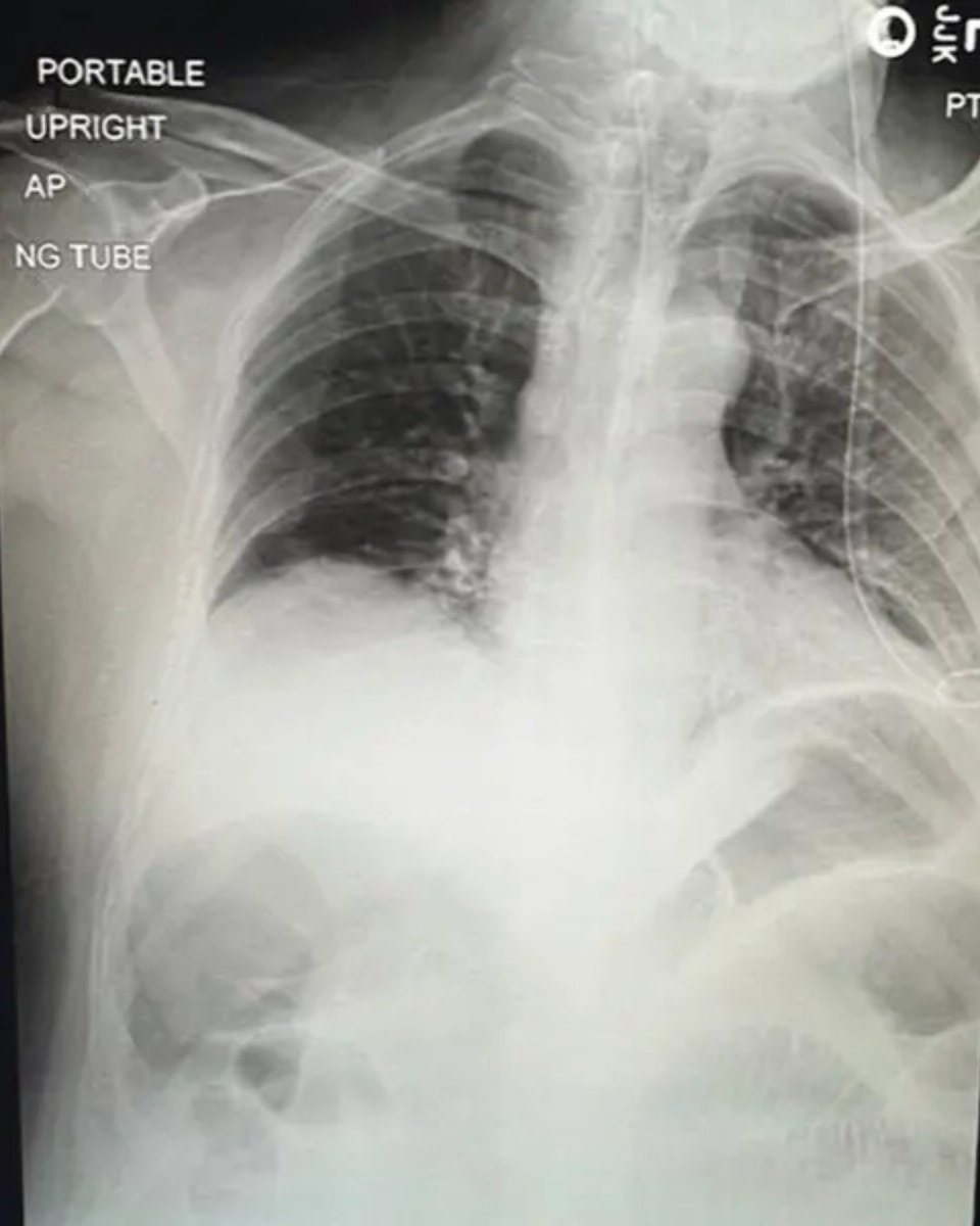 anesthesianews's tweet image. A central line that crossed the midline? 👀
Rare—but real.
This case highlights:
⚠️ RIJ catheter → left subclavian vein
⚠️ Altered anatomy can redirect placement
⚠️ Imaging confirmation is non-negotiable anesthesiologynews.com/a/EDkBAA/t #PatientSafety #Anesthesiology