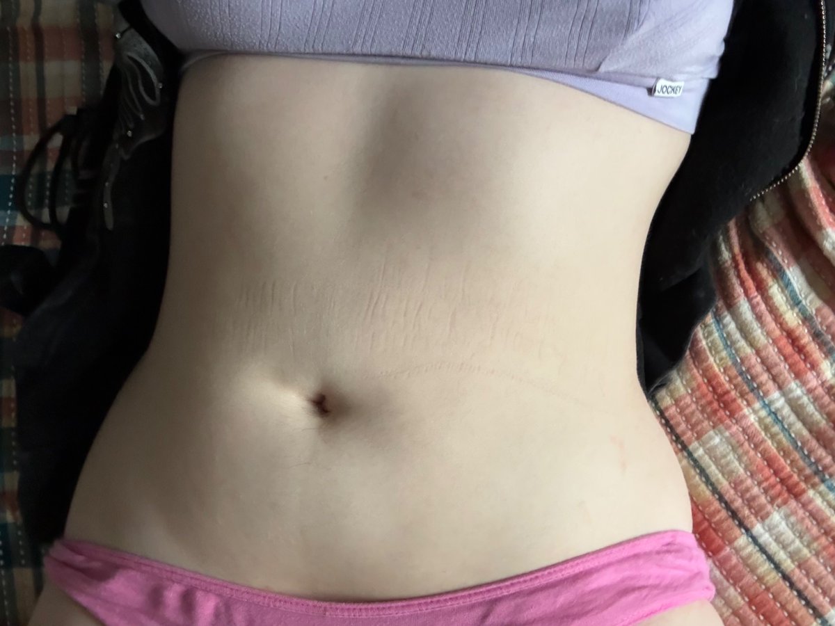 Emmy1048453's tweet image. 125 lbs on 4”10 btw😭gained. I disgust myself so much im gonna omad for two days then fast someone do it with me #shedtwt #edtwt #fatspo
