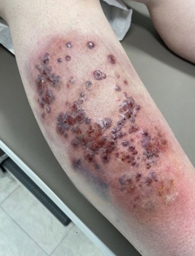 schowardjd's tweet photo. A woman in her 40s w/ a 4-yr hx of Hurley stage III HS presented w/ chronic drainage from the axillae, inframammary folds, & pelvis, along with a 2-mo hx of this painful ulcerating violaceous nodules on both lower extremities. She had no hx or clinical evidence of severe acne/acne conglobata.

What’s your DDx❔