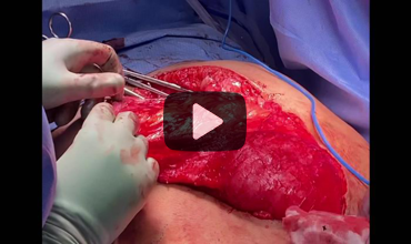 ORMgmtNews's tweet image. Preperitoneal repair of a large incisional hernia — step-by-step.
Monica Polcz, MD, MS, shares key technique insights in this “Know Your Hernia” video. ormanagement.net/a/HTcBAA/t #hernia #surgery