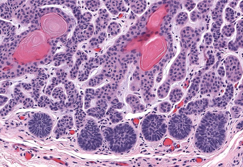 JMGardnerMD's tweet image. 50 yo M. Multiple linear papules on shoulder &amp;amp; arm for many years. Diagnosis? 
Answer ✅ youtu.be/xqUv1LAA5ac?si…
WSI digital slide: kikoxp.com/posts/8157 
More pics: kikoxp.com/posts/15214 
#pathology #pathologists #pathTwitter #dermpath #dermatology #dermtwitter