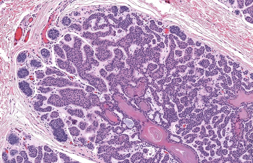 JMGardnerMD's tweet image. 50 yo M. Multiple linear papules on shoulder &amp;amp; arm for many years. Diagnosis? 
Answer ✅ youtu.be/xqUv1LAA5ac?si…
WSI digital slide: kikoxp.com/posts/8157 
More pics: kikoxp.com/posts/15214 
#pathology #pathologists #pathTwitter #dermpath #dermatology #dermtwitter