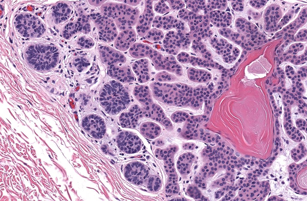 JMGardnerMD's tweet image. 50 yo M. Multiple linear papules on shoulder &amp;amp; arm for many years. Diagnosis? 
Answer ✅ youtu.be/xqUv1LAA5ac?si…
WSI digital slide: kikoxp.com/posts/8157 
More pics: kikoxp.com/posts/15214 
#pathology #pathologists #pathTwitter #dermpath #dermatology #dermtwitter