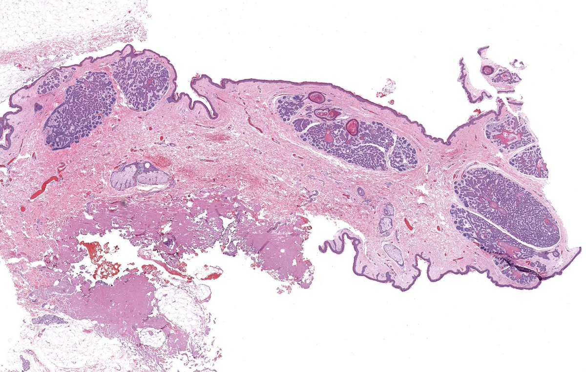 JMGardnerMD's tweet image. 50 yo M. Multiple linear papules on shoulder &amp;amp; arm for many years. Diagnosis? 
Answer ✅ youtu.be/xqUv1LAA5ac?si…
WSI digital slide: kikoxp.com/posts/8157 
More pics: kikoxp.com/posts/15214 
#pathology #pathologists #pathTwitter #dermpath #dermatology #dermtwitter