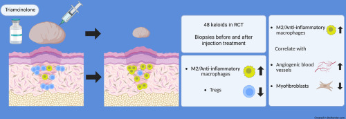 ResearchTauh's tweet photo. Hot off the press. Recruitment of anti-inflammatory M2 macrophages are important for  keloid resolution after corticosteroids therapy. A double-blinded,  randomized, controlled trial.
 https://t.co/MdNzpnoxDM https://t.co/CnXZxdpQ6l