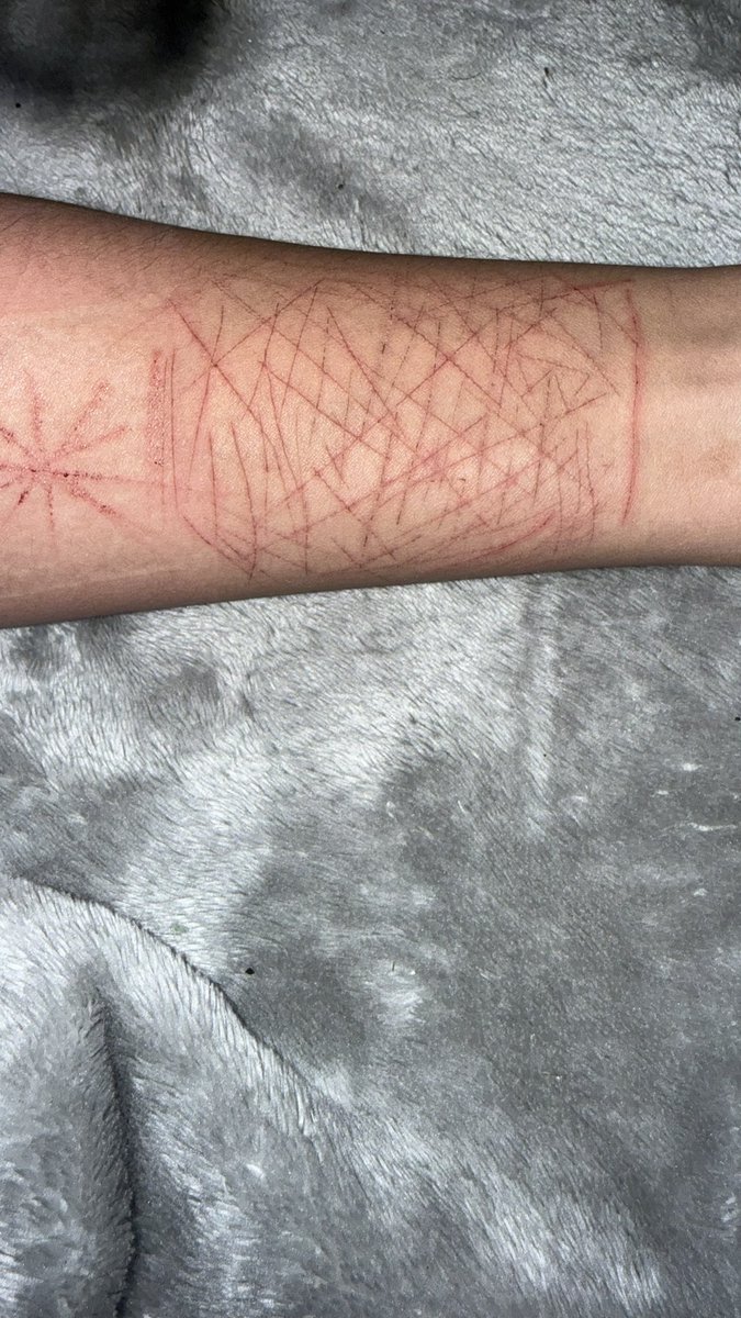 ixusxo's tweet photo. IMPORTANT question 
do yall think or know if these will heal and be less noticeable by may 8 for a dance ??? 
like i rlly dk plss help #shtwt #shedtwt https://t.co/eFItasgLis