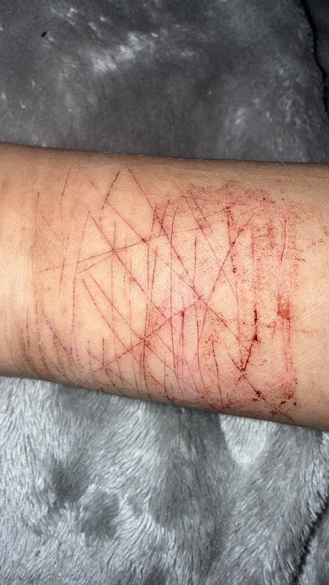 ixusxo's tweet photo. IMPORTANT question 
do yall think or know if these will heal and be less noticeable by may 8 for a dance ??? 
like i rlly dk plss help #shtwt #shedtwt https://t.co/eFItasgLis