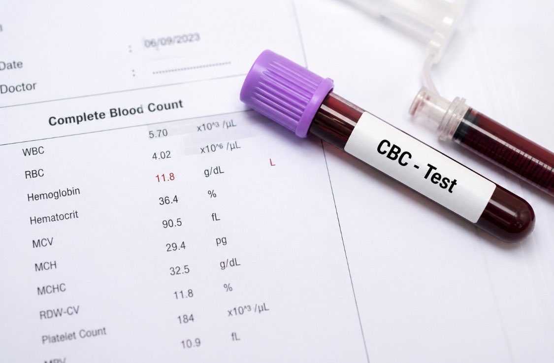 ai_diagnostics's tweet image. 🩸 The #1 test you should get at least once a year — Complete Blood Count (CBC).
It reveals anemia, inflammation, immune issues, and hidden infections.
Hemoglobin below 130 (men) / 120 (women)? See a doctor ASAP!
#BloodTest #HealthCheck #Wellness