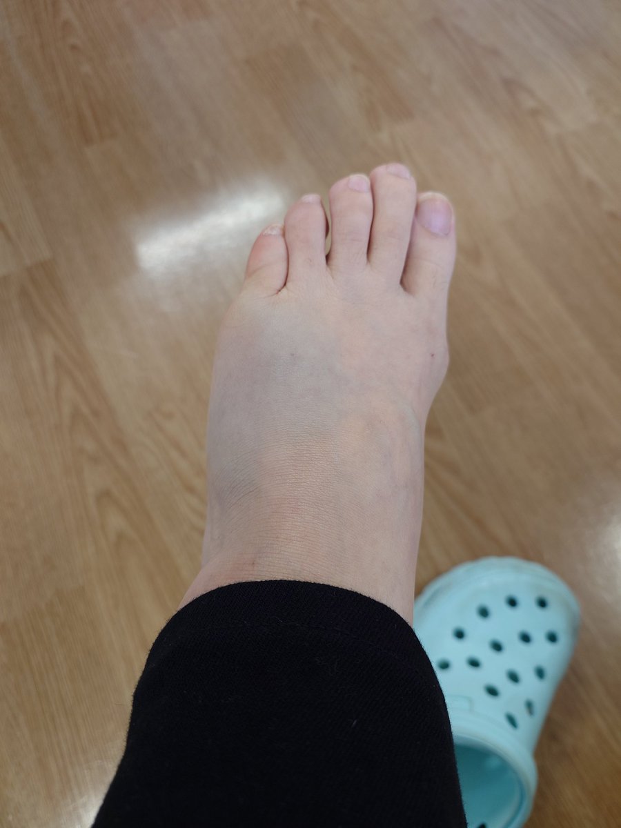 pochitoRose's tweet photo. 朝起きたら足に激痛が😭
医師曰く骨折とのこと。
はぁ？ https://t.co/aKv0z8RycP
