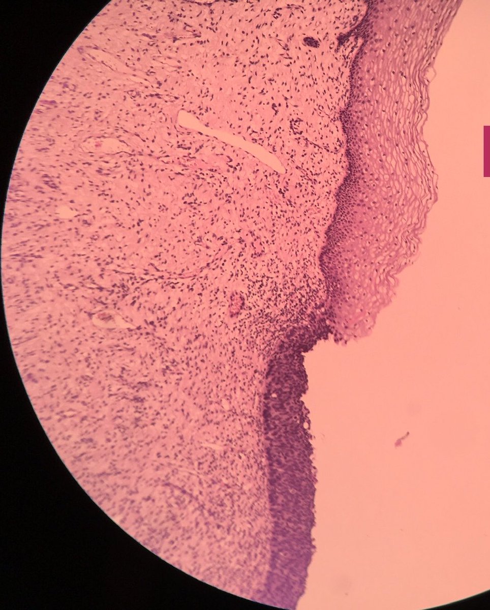 ManjulaNavamani's tweet image. Identify the organ and diagnosis!!!
What is the characteristic finding observed here???
#learnpathologywithmanju 
#pathx #pathtwitter
#histopath #pathresidents 
#gynecpathology