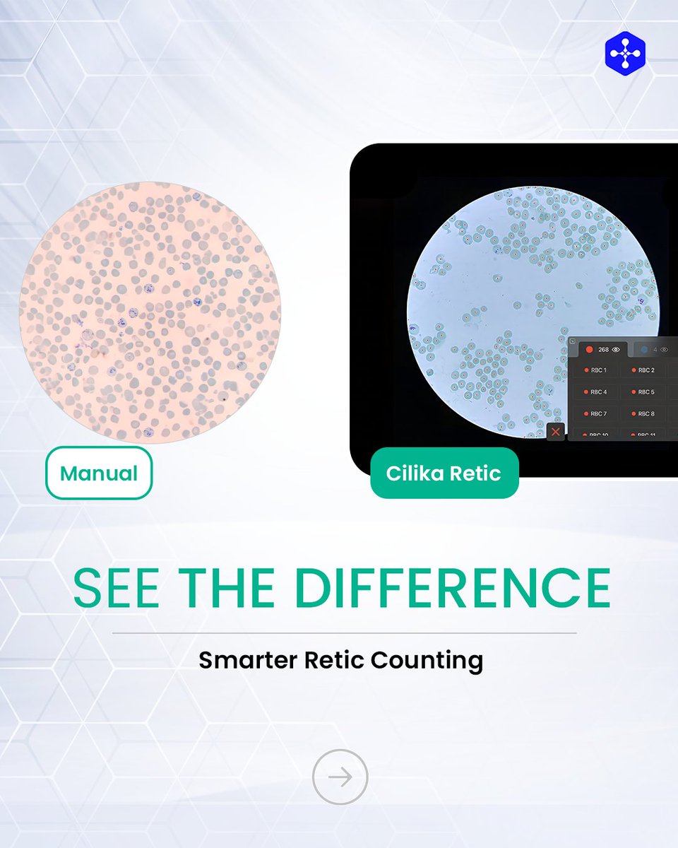 medprimetech's tweet photo. Tired of the 30-minute manual retic grind? The Cilika Retic AI module is here to change the game. By automating the identification of immature red blood cells, we’ve turned a tedious task into a 2-minute precision report.

#CilikaRetic #DigitalMicroscopy #AILab #PathologyTech https://t.co/hPkXHYqwQV