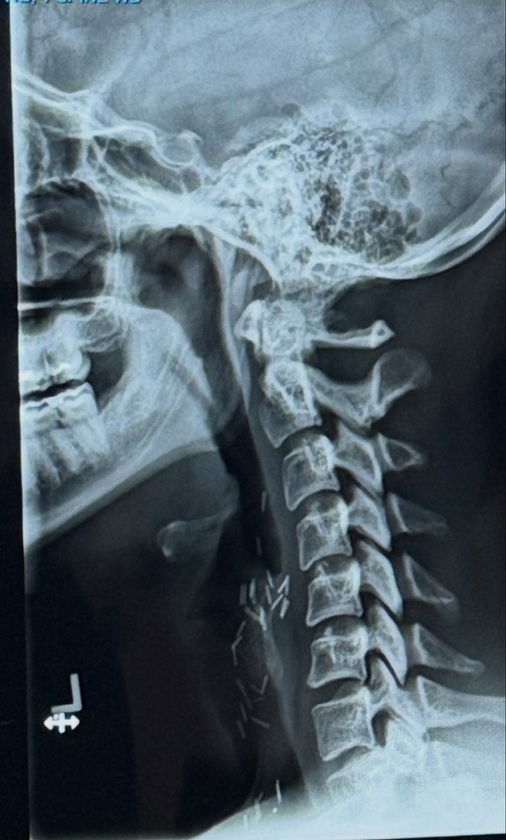 MercedesBerea's tweet image. Proof God exists, 79 metal clips in my neck and I'm here to say I LIVED they said I would not make it nevermind sing ! And I'm doing just that !!! Praise the Lord! #goddid