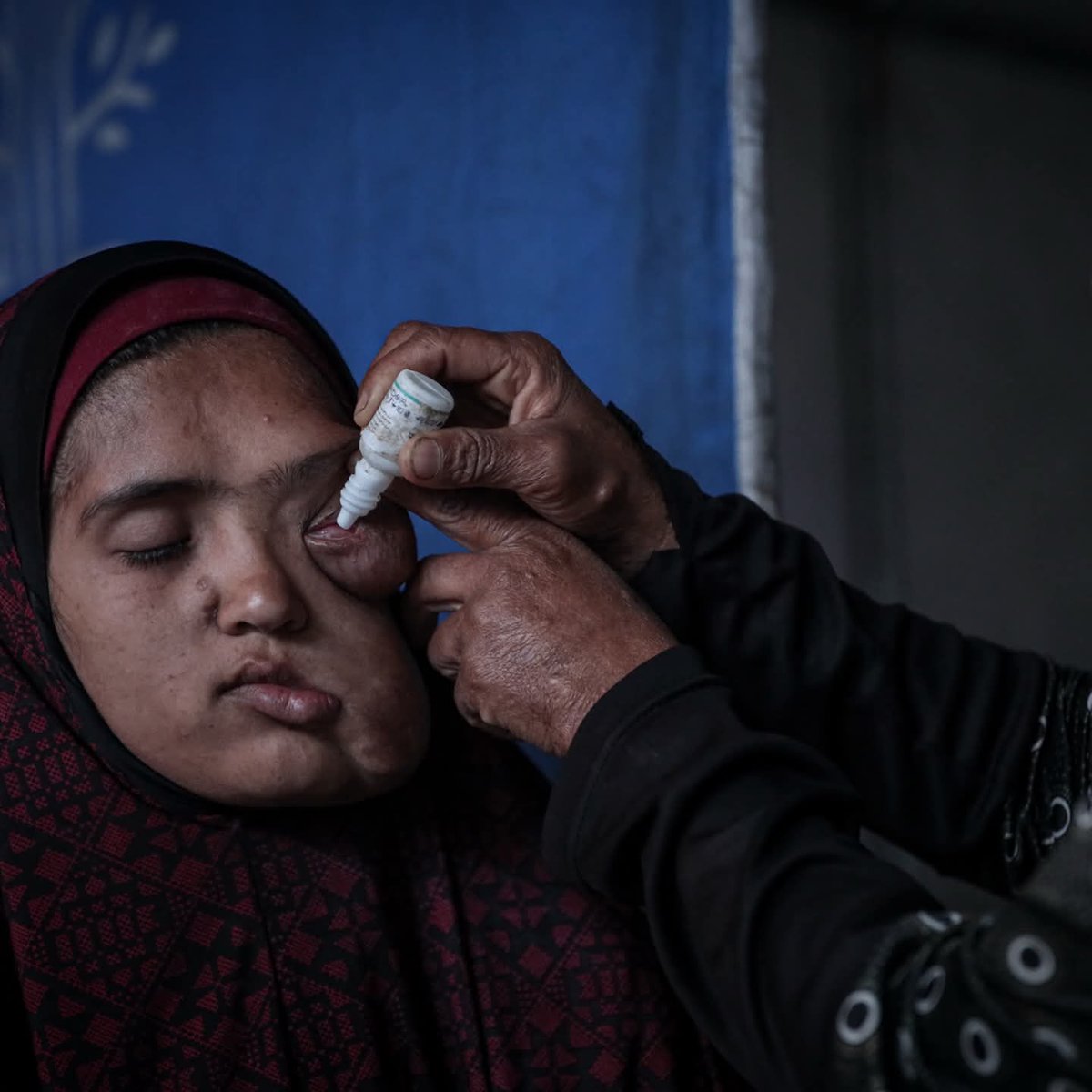 A Palestinian young woman struggles to access treatment in Gaza

Gaza City, Gaza, Palestine – April 28: 18-year-old Palestinian Inshirah Al-Madani was seen in a tent as she battles facial cancer. Restrictions on border crossings and limited access to medication have prevented her