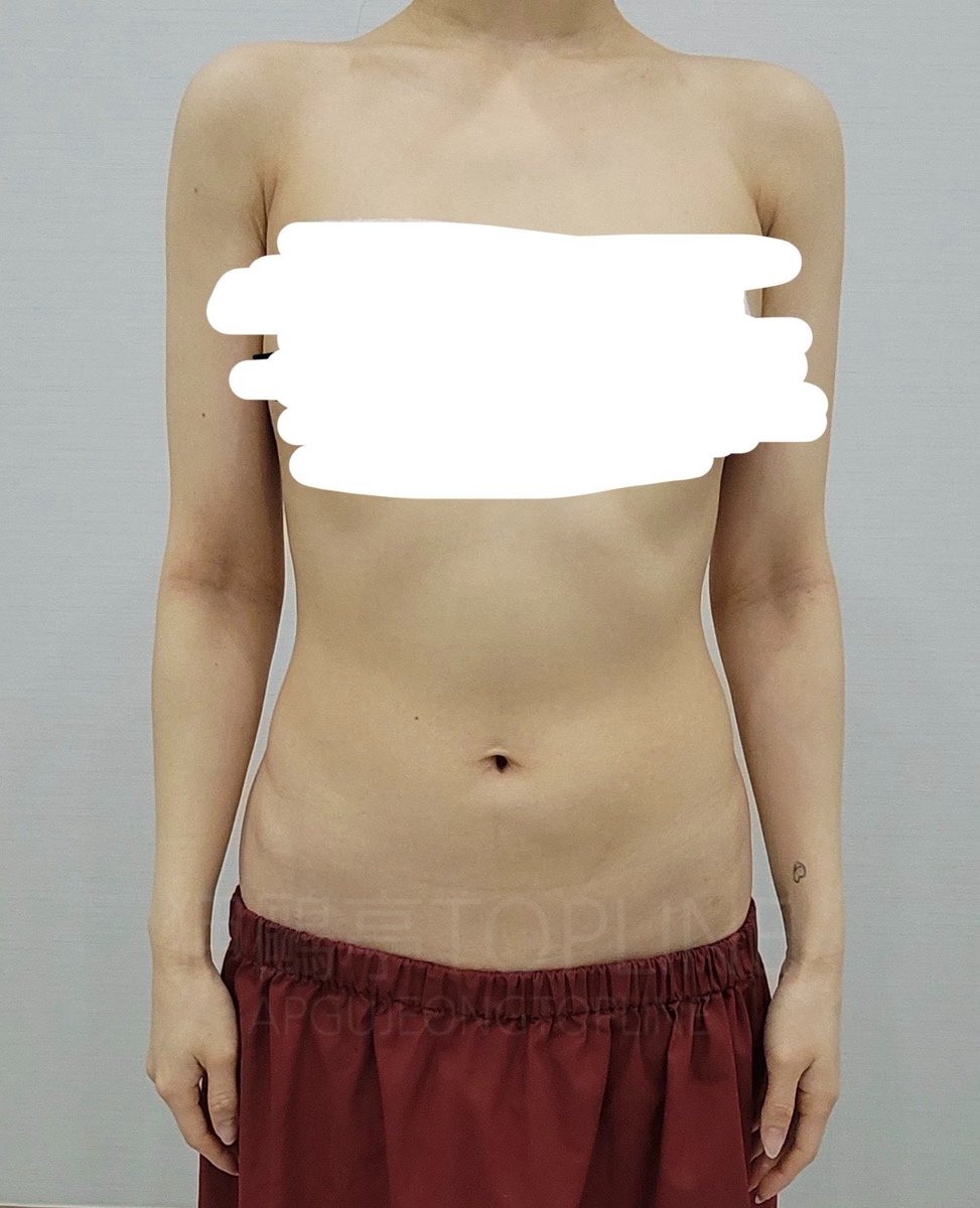 お腹とラブハンドル(腰回りとお腹の後ろ)の脂肪吸引1ヶ月半後の変化がすごい🤩❤️
めっちゃくびれできたなぁ🥺
やっぱり狎鴎亭TOP LINEさんの技術はすごい!
(一枚目→手術直前、2枚目→今日)
@aptopline1675 https://t.co/xOwXY2GwPB