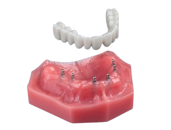 mdicasyracuse's tweet image. Are you looking for minimally invasive but just as effective All-on-4 alternatives? Try the Fix-on-Six method at Brent Bradford, DDS today! #syracuse #implant #dentist bit.ly/3QfxmdZ