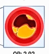 SaranMarwaha's tweet photo. Fit athlete.....can still get coronary calcium and coronary artery disease ....why? 
Latest research suggests......
 https://t.co/kt5aAfy21M…
We are starting to crack the code.....@JODriscoll9 @SSharmacardio @MichaelPapadak2 @BJSM_BMJ @CityStG_Health @CRY_UK https://t.co/yXh237PJ5V