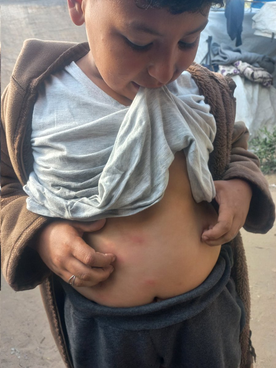 Ahmadamarm23's tweet image. As you can see, my brother Mahmoud has contracted a mosquito and germ infection. We urgently need your donations to purchase his medication. Thank you. 🦟💔🇵🇸😢💊