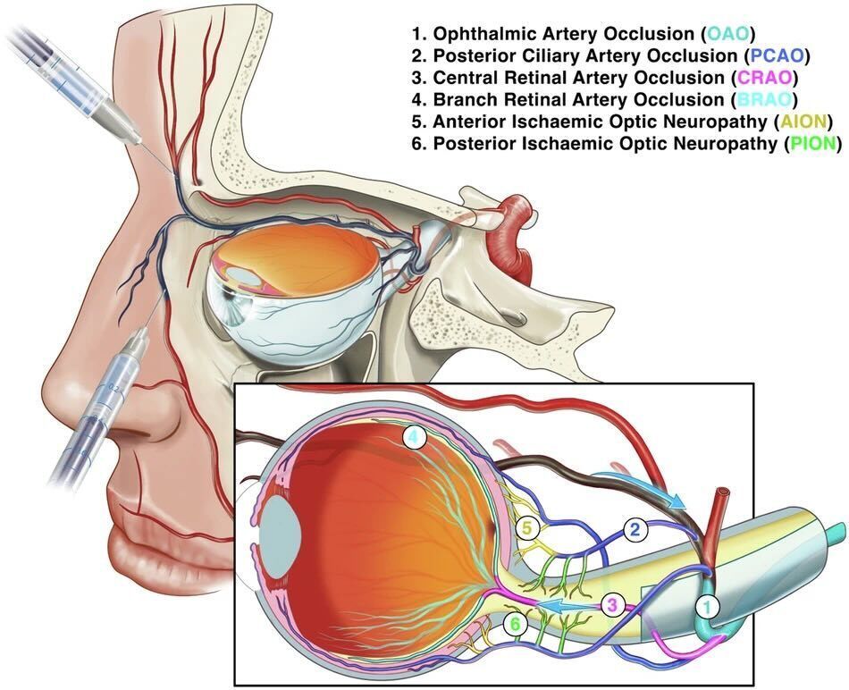 Eye_Journal's tweet image. Soft tissue filler use is rising, and so are serious complications.

New UK consensus guidelines in Eye set out how to manage tissue filler induced vision loss. Cases have increased worldwide. Rapid recognition and referral are critical.

nature.com/articles/s4143…

#Ophthalmology