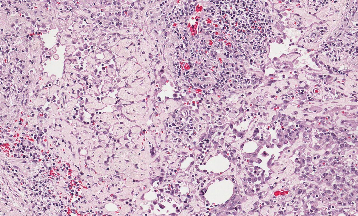 JMGardnerMD's tweet image. 80 yo man with growing violaceous nodule on scalp. Your diagnosis? 
Answer ✅ youtu.be/iDIECp58AhI?si…
WSI digital slide: kikoxp.com/posts/3030. #pathology #pathologists #pathTwitter #dermpath #dermatology #dermatologia #dermtwitter #BSTpath